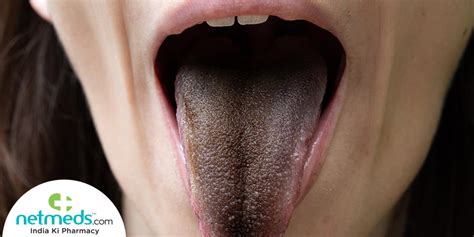 waking up with black tongue|black stuff on my tongue.